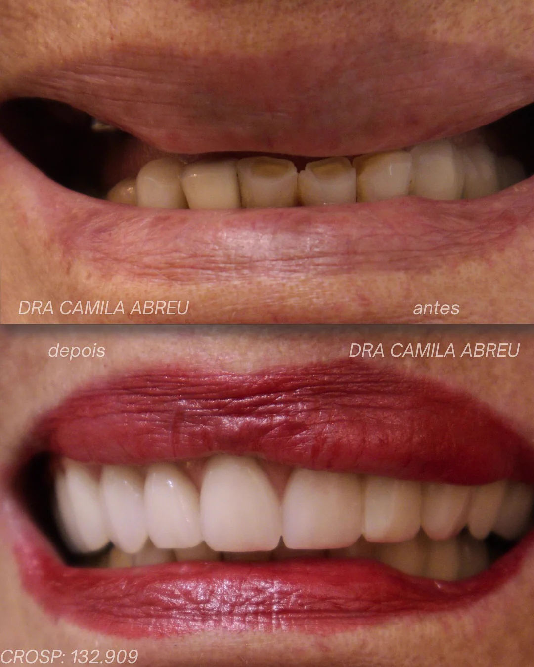 Antes e depois: Protocolo de carga imediata