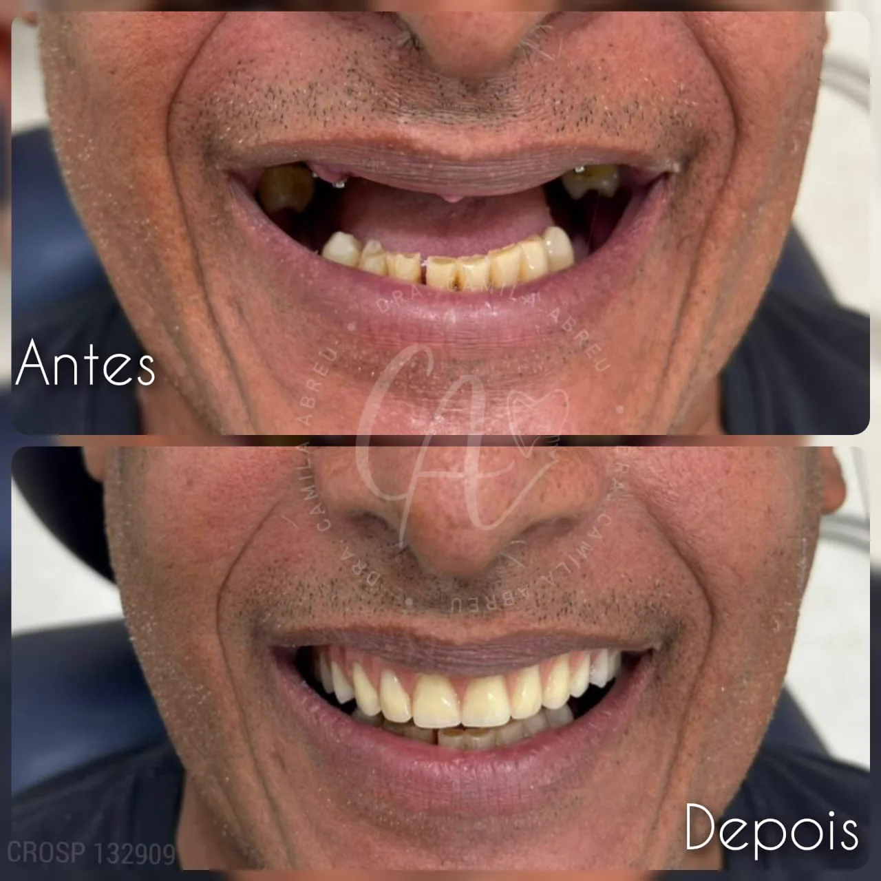 Antes e depois: Transformação planejada do sorriso