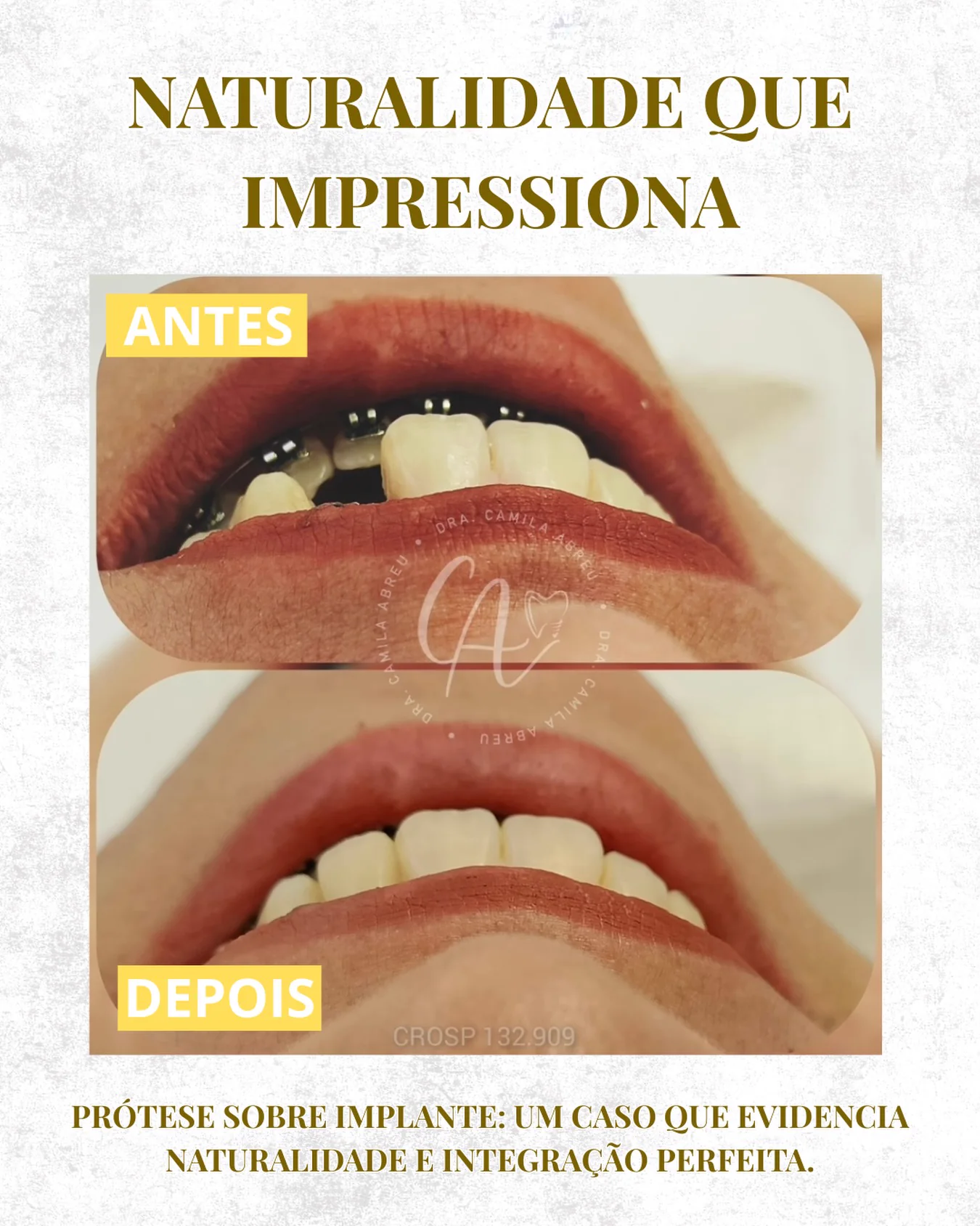 Antes e depois: Prótese sobre implante integrada ao sorriso
