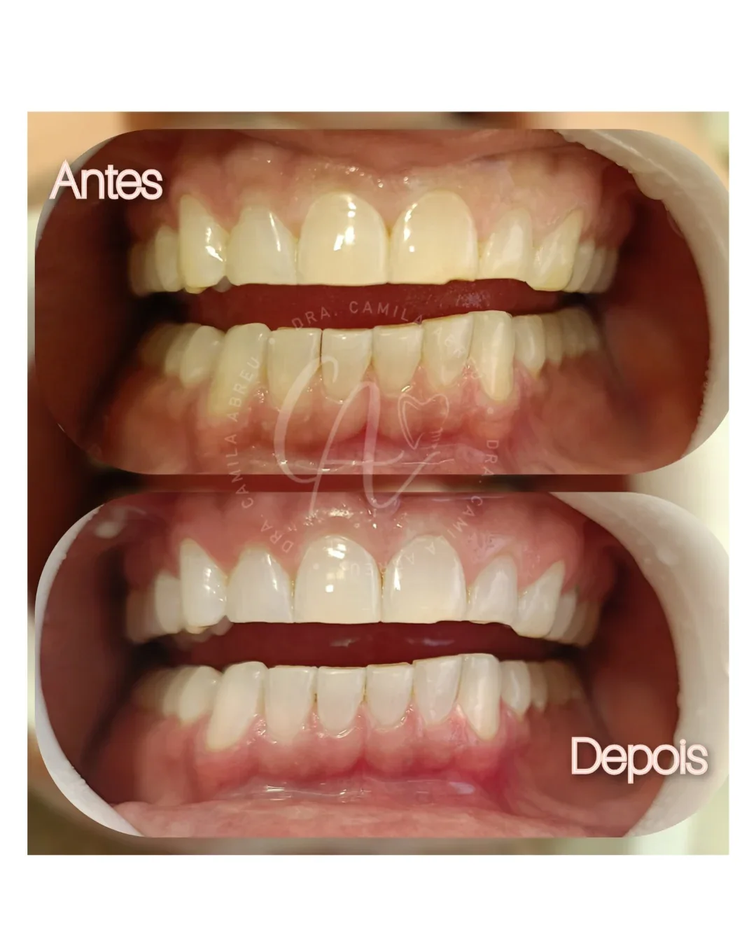 Antes e depois: Antes e depois do clareamento dental
