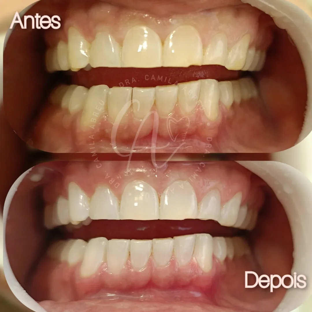 Antes e depois: Clareamento com naturalidade