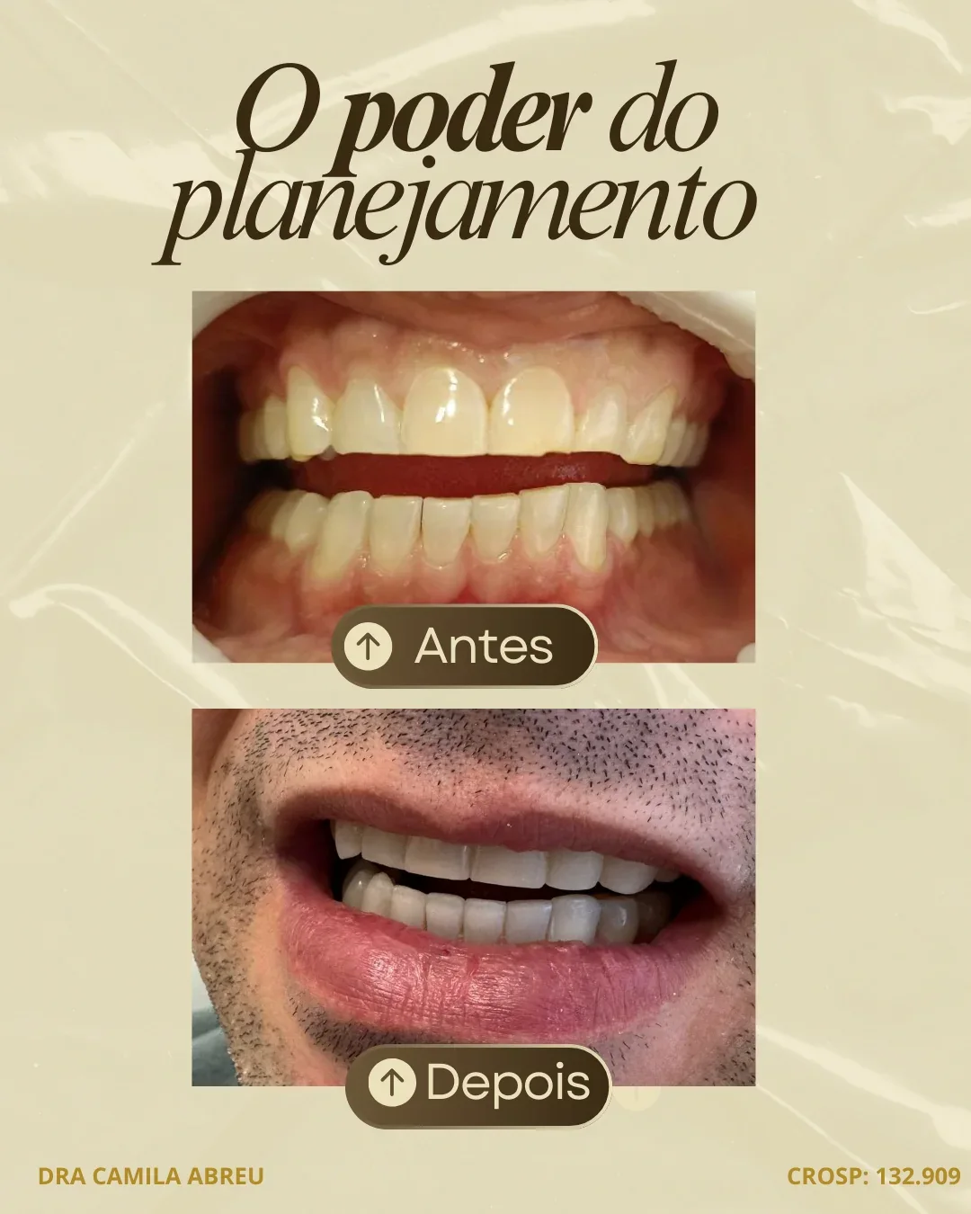 Antes e depois: Resinas e clareamento