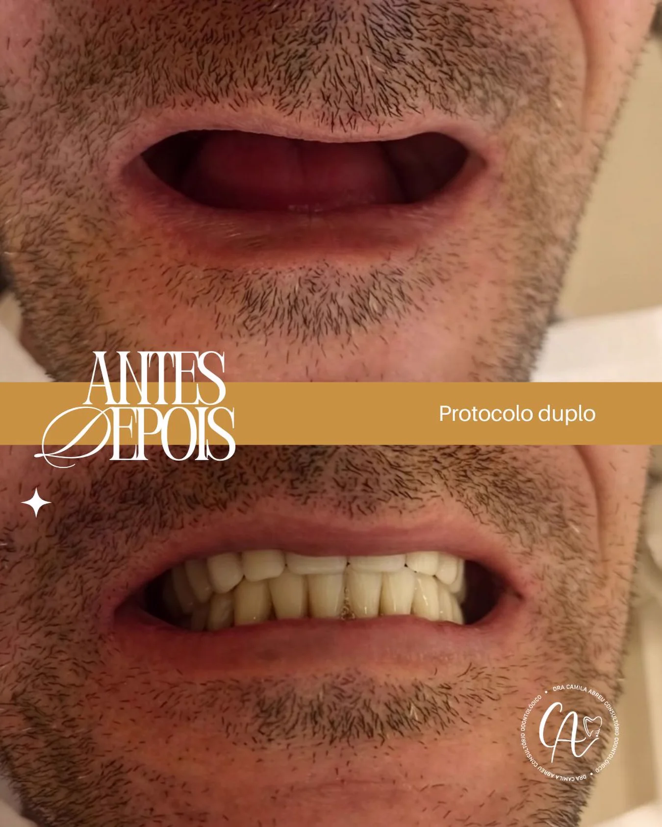 Antes e depois: Reabilitação com protocolo duplo