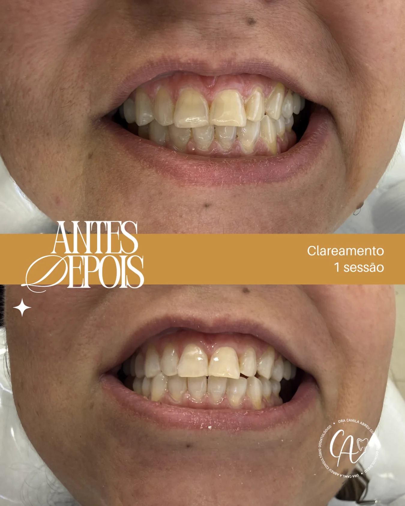 Antes e depois: Clareamento dental — primeira sessão