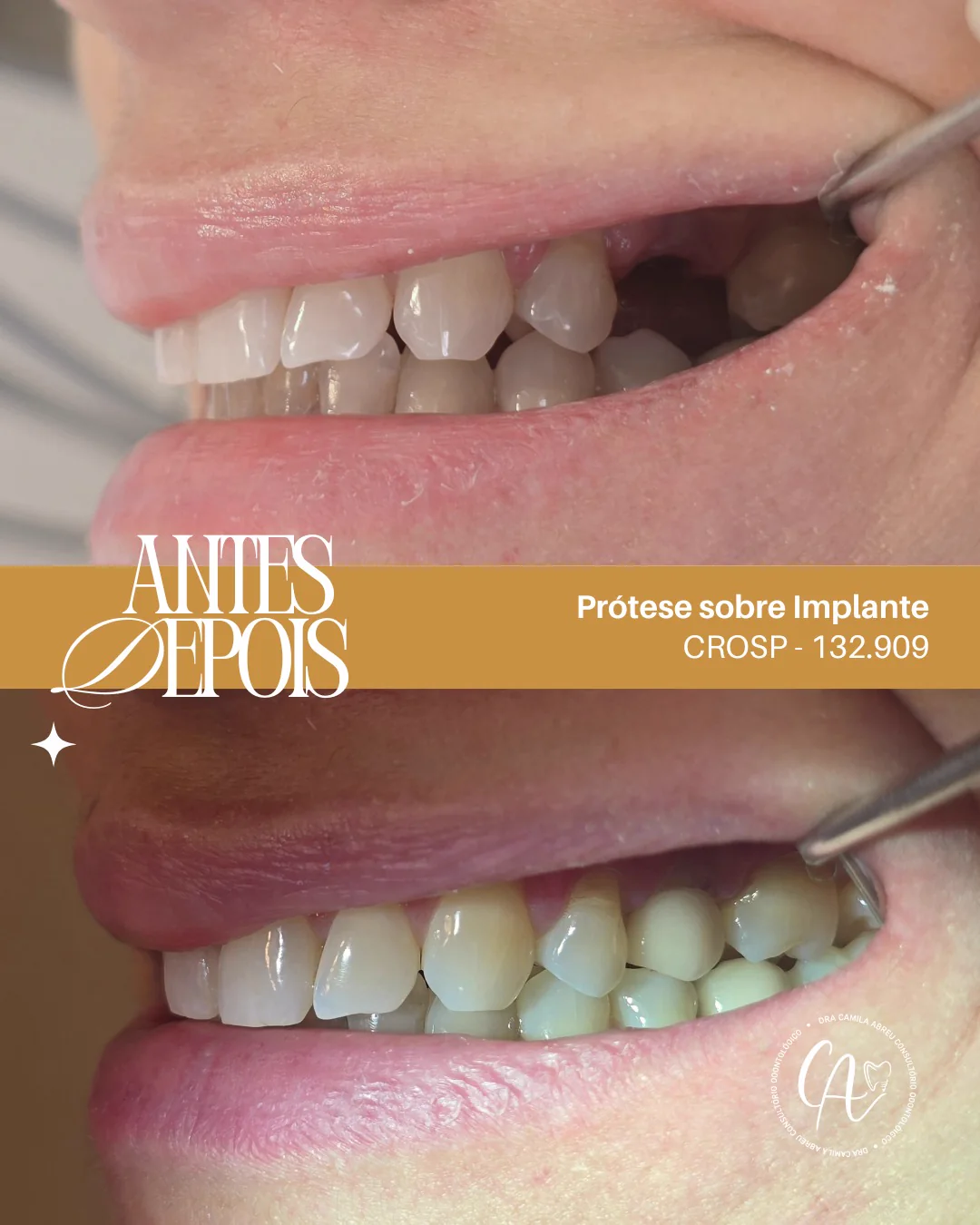 Antes e depois: Naturalidade em prótese sobre implante