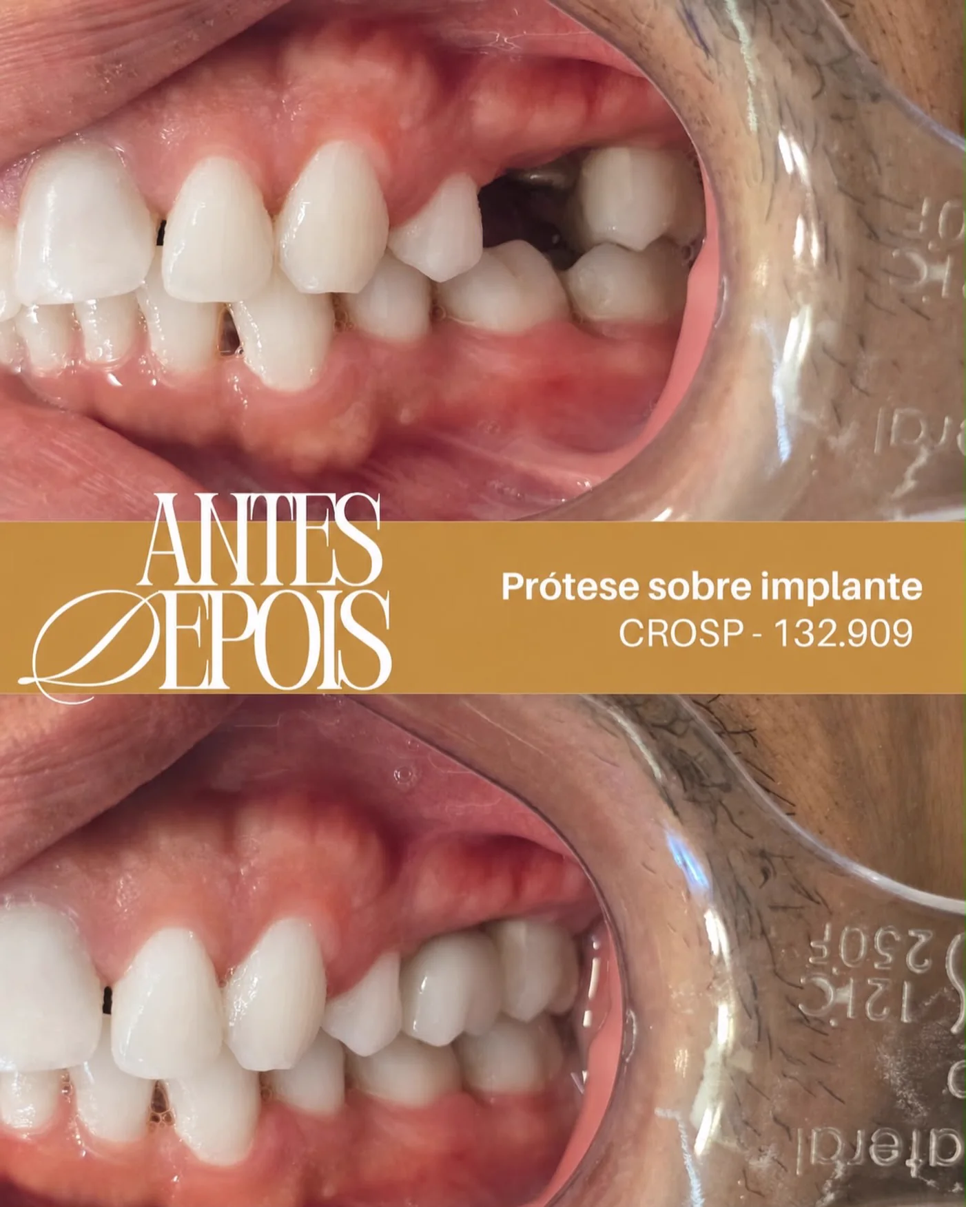 Antes e depois: Prótese sobre implante