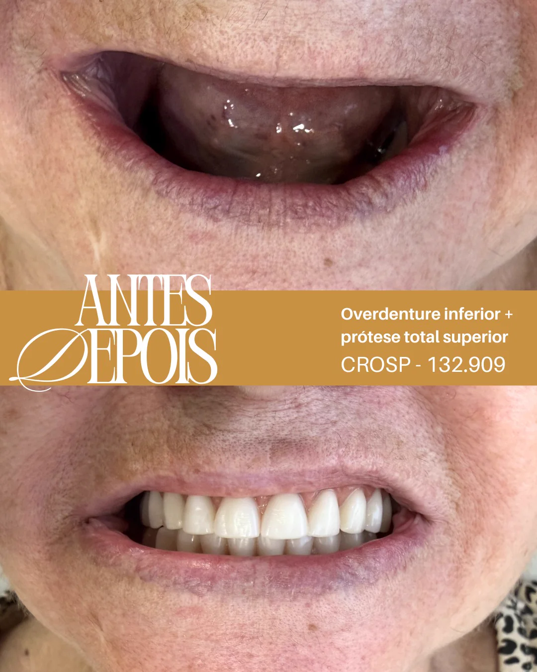 Antes e depois: Overdenture inferior e prótese total superior
