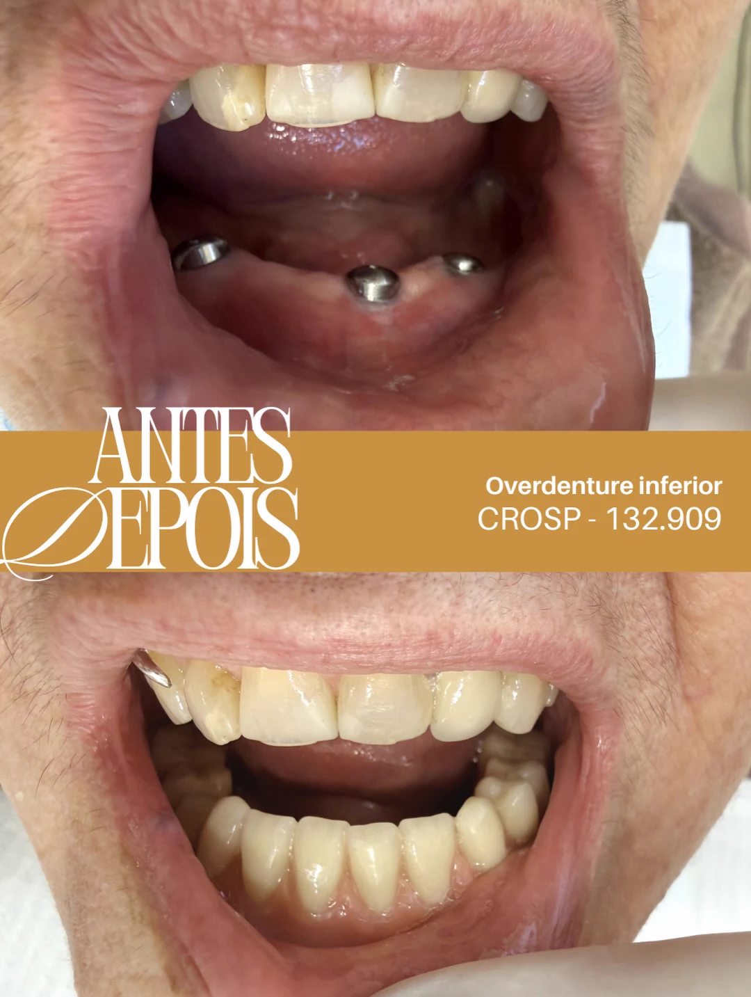 Antes e depois: Overdenture inferior