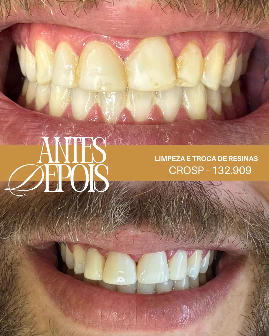 Antes e depois: Limpeza e troca de resinas
