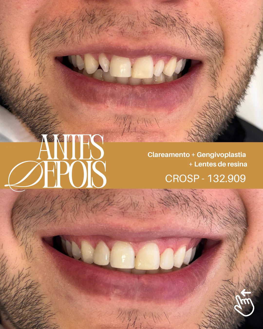 Antes e depois: Clareamento, gengivoplastia e lentes de resina