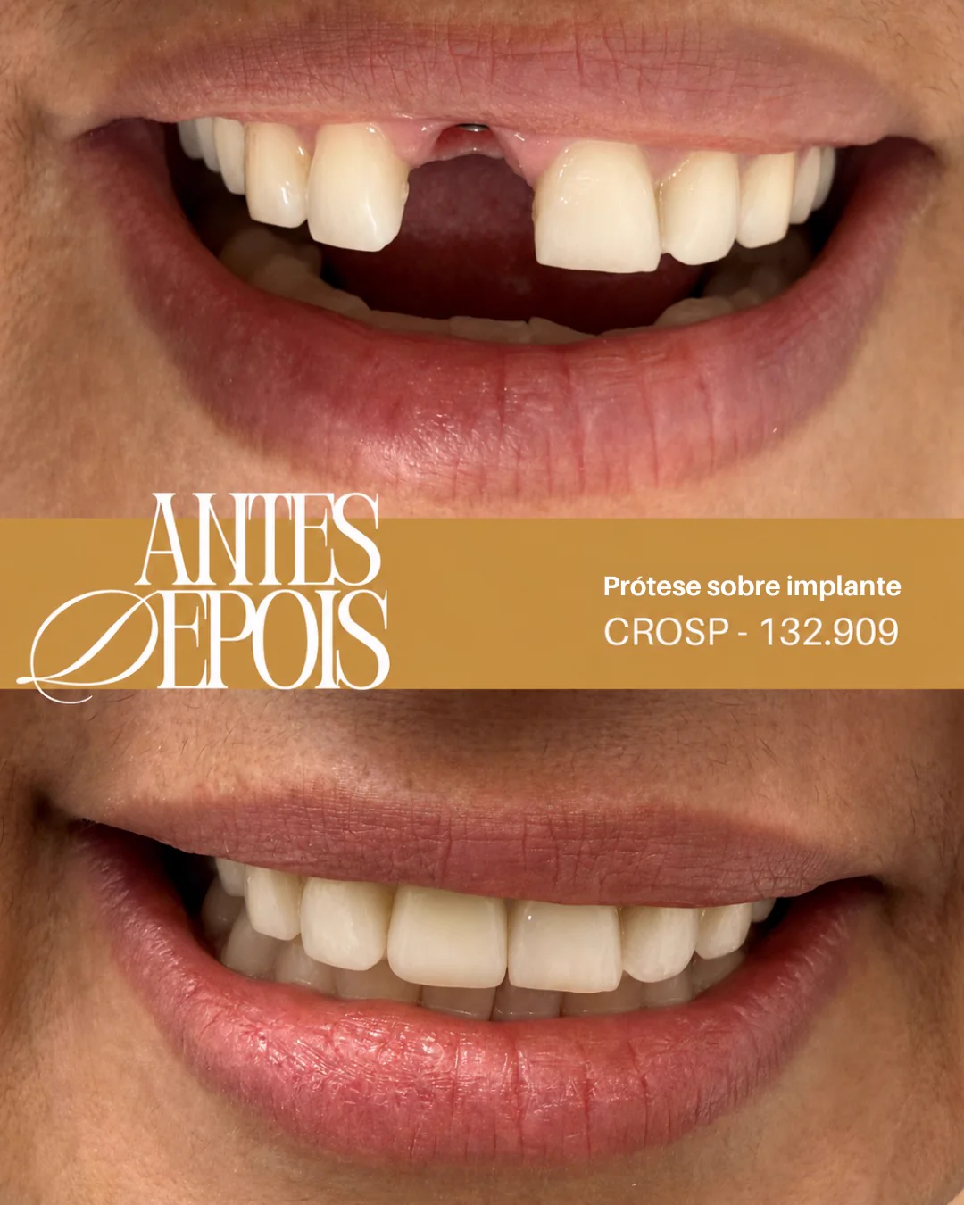 Antes e depois: Prótese sobre implante
