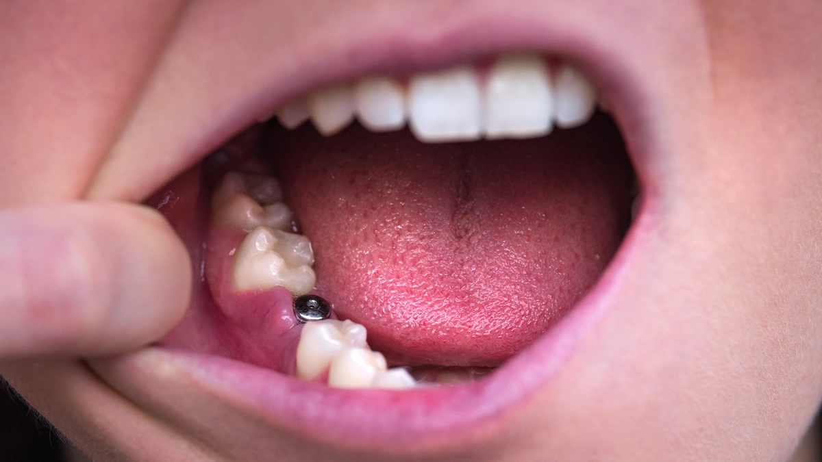 Implante dentário vale a pena? O que considerar antes de decidir