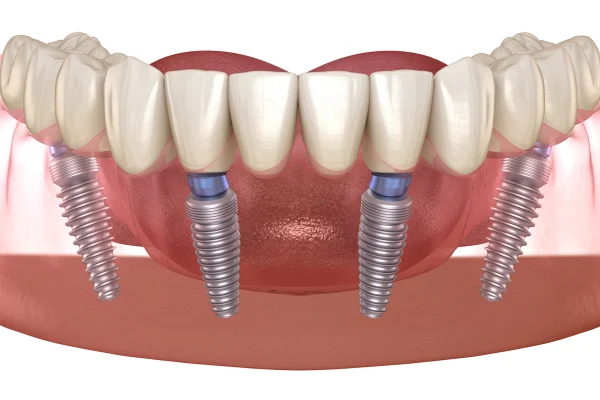 Implante-Dentário-Tudo-o-Que-Você