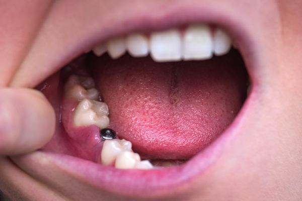 implantes-2